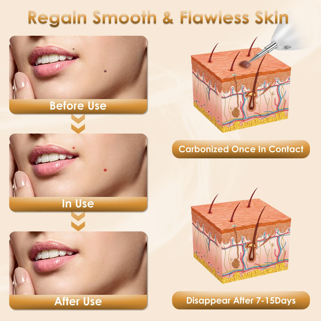 Rechargeable Mole & Wart Remover